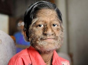 Hypertrichosis